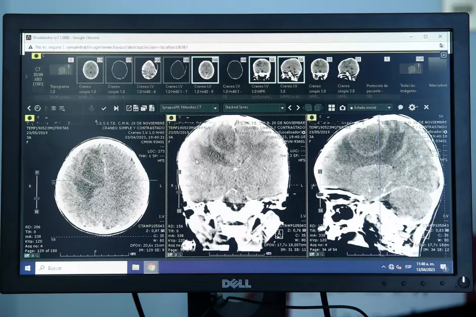 Retiran absceso cerebral extenso a nia