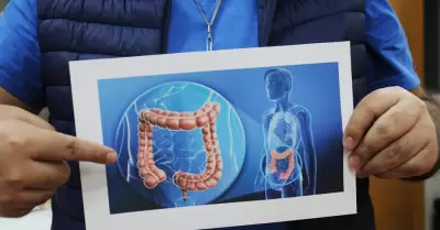 ENFERMEDAD INFLAMATORIA INTESTINAL