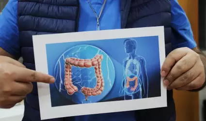 ENFERMEDAD INFLAMATORIA INTESTINAL