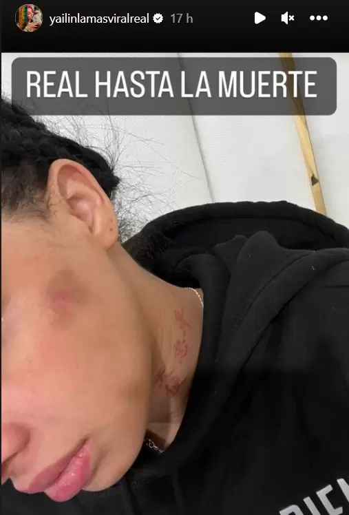 Marcas de golpes en el rostro de Yailin.