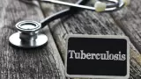 Tuberculosis