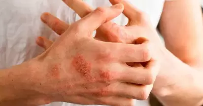 Dermatitis