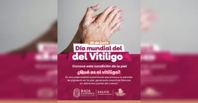 Vitligo