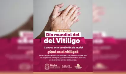 Vitligo