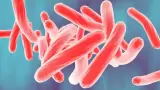 Tuberculosis