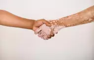 Secretar�a de salud promueve la inclusi�n y sensibilizaci�n sobre el vitiligo en Baja California